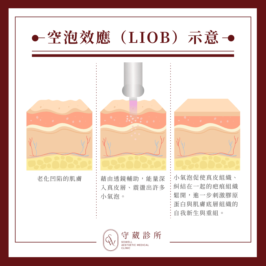 空泡效應示意圖